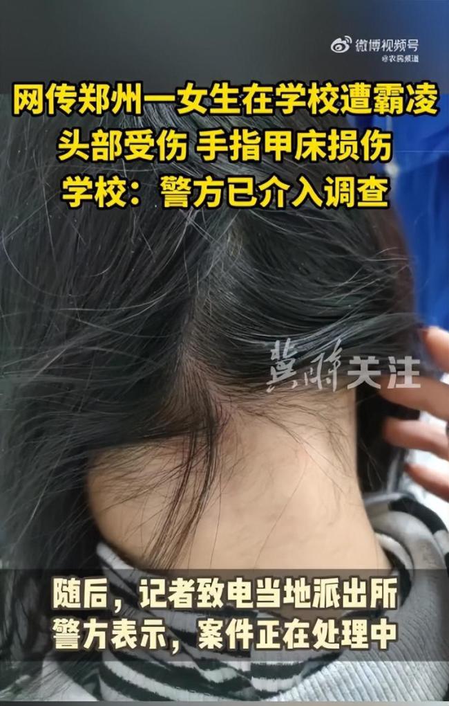 网传河南一女生遭多人霸凌指甲被打脱落 学校称警方已介入调查