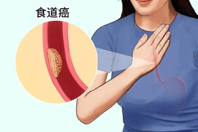 全球一半食管癌在中国！家中3种食物尽早撤下餐桌