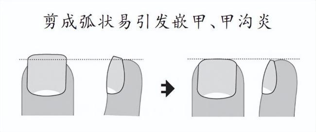 剪指甲时去掉的那块“死皮”，其实一直在保护你