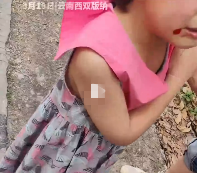 女孩被野猴咬伤，母亲：去打野猴还咬着不放