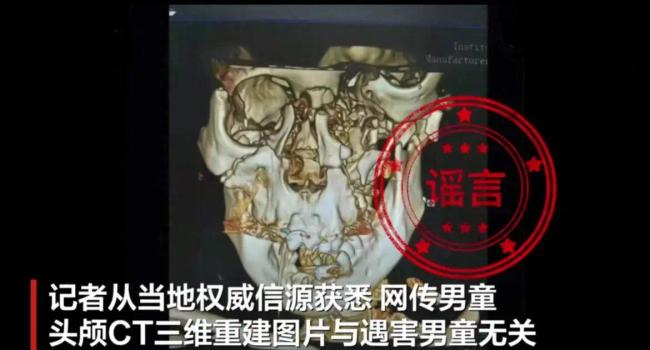 邯郸遇害男童尸检头部背部有伤网传头部ct照片不实