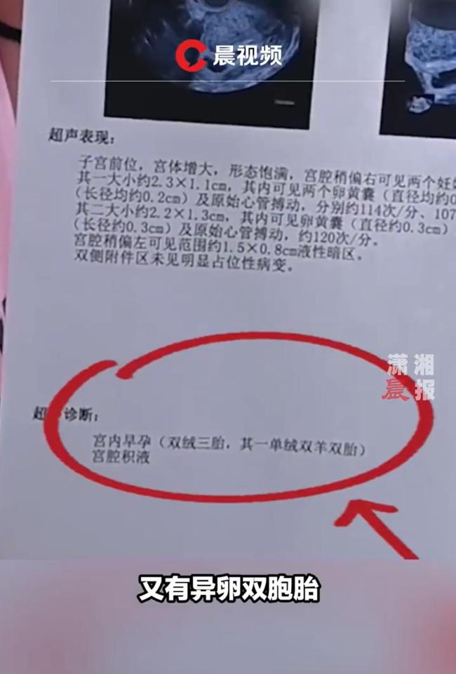 医生惊呼:双胞胎要么同卵双胞胎,要么异卵双胞胎,这个既有同卵双胞胎