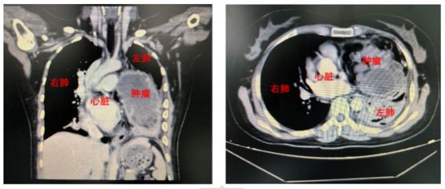 32岁女子大咳血紧急入院！查出体内有20岁肿瘤