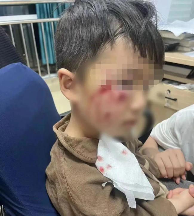 3岁男童被狗咬伤离世 接种疫苗为何“无效”？