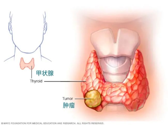 这种癌症发病率30年升高了3倍