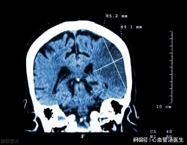 动脉硬化等三类血管病变哪个最危险 中老年需警惕