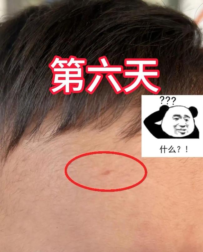 宝妈用狗尾巴草给孩子点痣惊呆网友 传统VS现代的育儿抉择