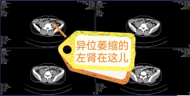 21岁小伙左肾萎缩成鹌鹑蛋 罕见异位肾致功能丧失