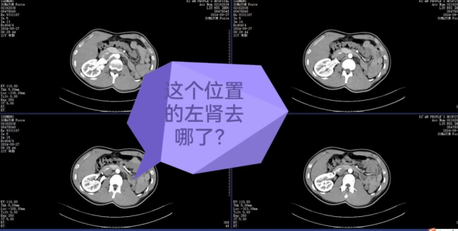 21岁小伙左肾萎缩成鹌鹑蛋 罕见异位肾致功能丧失