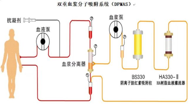 女子为消结节吃保健品2个月后肝衰竭 人工肝助其康复