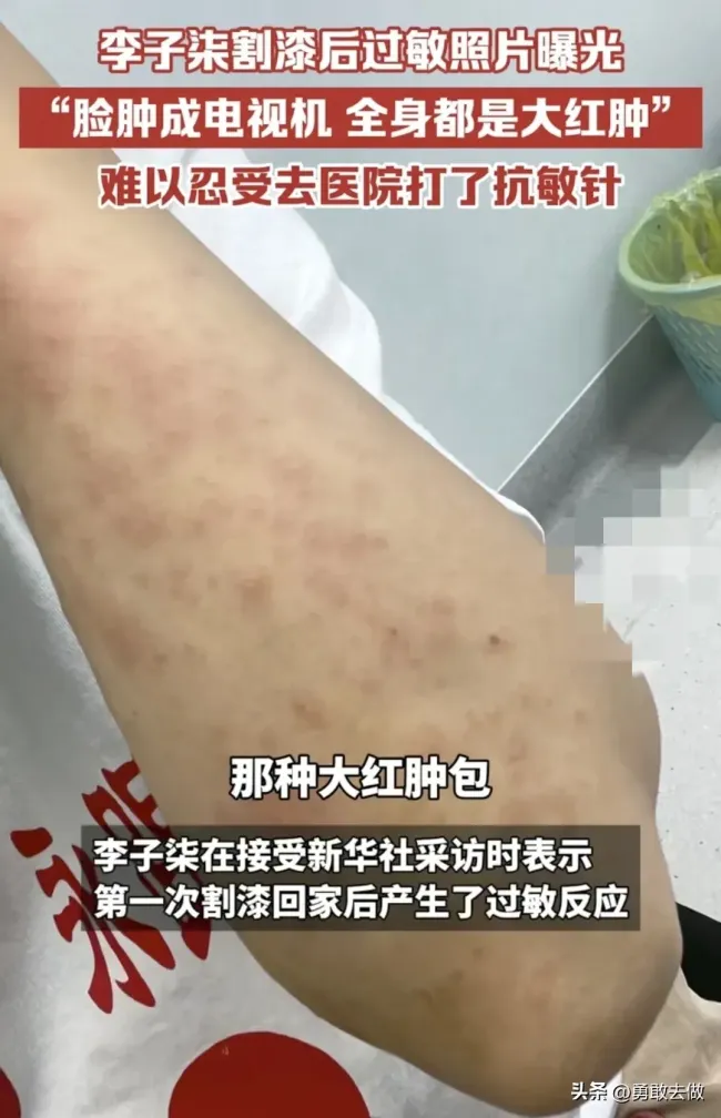 李子柒曾生漆过敏全身红肿 坚强微笑感动网友