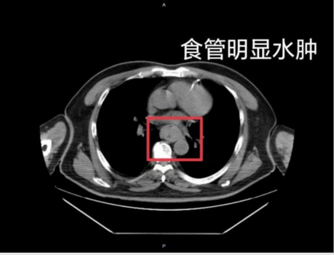 一口"热辣滚烫"男子吐血休克 "趁热吃"可能致癌