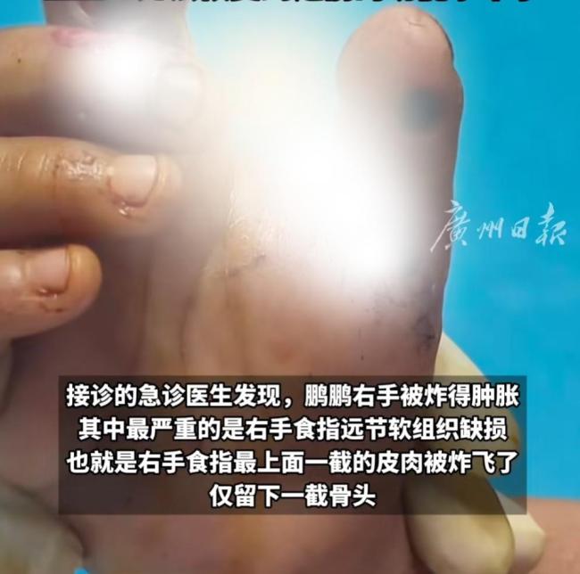 男孩玩鞭炮食指被炸只剩骨头 医生：手眼最易中招，近期高发