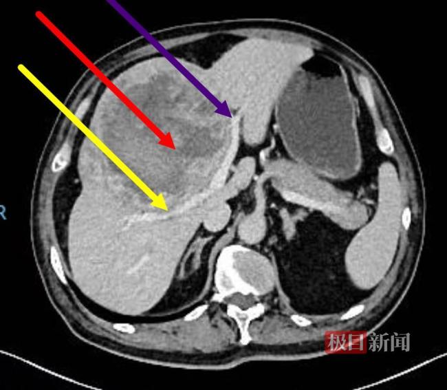 男子肝臟上藏巨大腫瘤 柚子大腫瘤成功切除