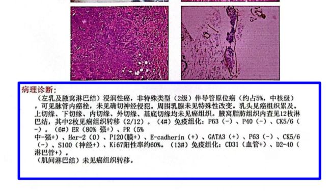 58歲男子胸部長拇指大疙瘩確診乳腺癌 罕見病例引關(guān)注