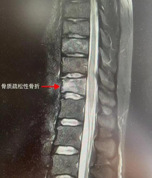 25歲女孩確診中度骨質(zhì)疏松 咖啡過量惹的禍