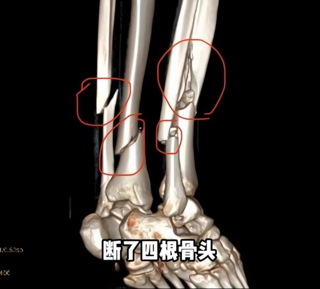 500萬粉網紅滑雪摔骨折 打24顆釘子 康復之路漫長