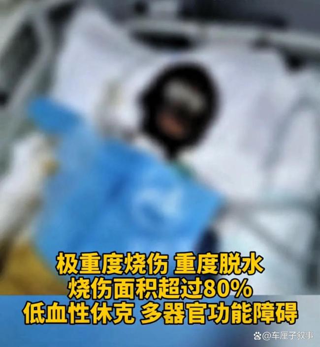 被泼汽油烧伤女孩称可能会直播带货 勇敢面对生活挑战