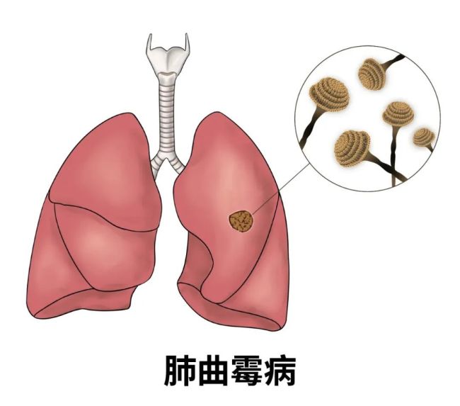 高烧40℃、肺部“发霉”，只因忽略一个细节！