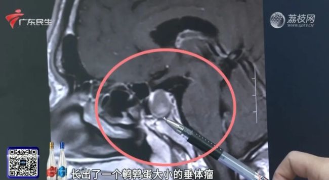 男子突然變丑 下唇比上唇厚一倍 竟是垂體瘤作祟