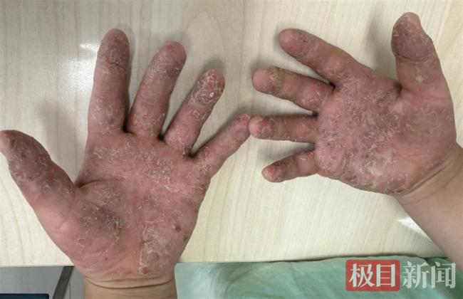 孫子長水皰奶奶上偏方 致其雙手潰爛