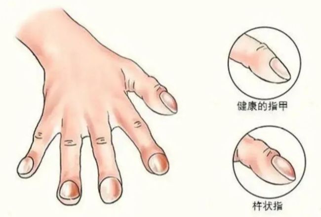 医生：身体有癌 双手先知，尤其是肝癌