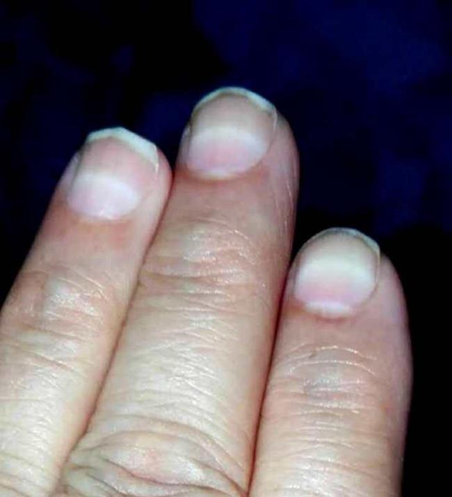 3歲女童查出急性鉈中毒 罕見病例引關(guān)注