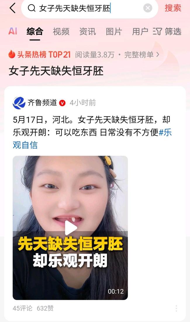 女子先天缺失恒牙胚