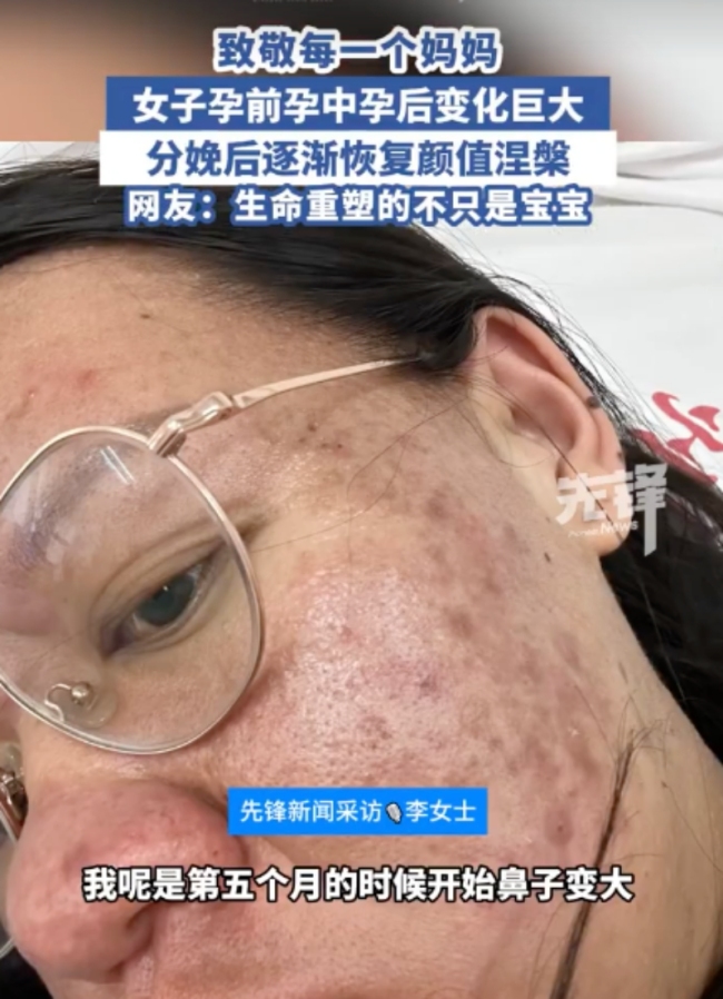 女子分享孕期分娩后容貌變化 孕激素下的變形記