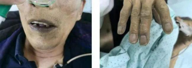 小伙亞硝酸鹽中毒 尿液呈藍色 解毒劑亞甲藍起效