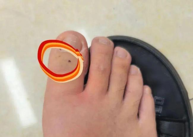 男子散步被青蛇咬后忍痛拍照 記下蛇特征求醫(yī)