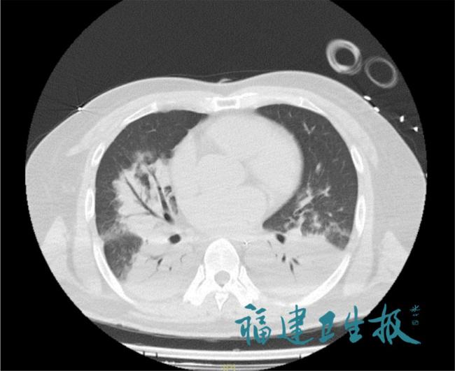 空調(diào)一年未清洗 男子吹出“白肺” 未清潔空調(diào)險釀大禍