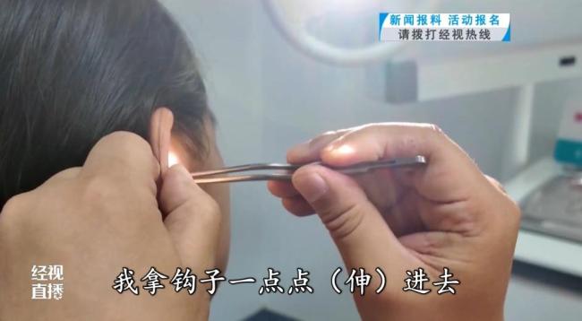 女童耳痛就医挖出所藏橡皮擦 两年“耳中秘密”揭晓