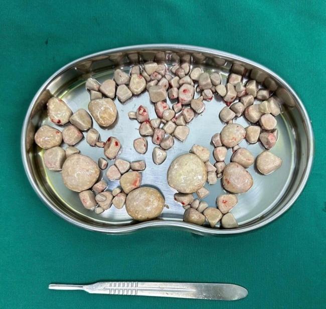 八旬老人膀胱取出100余颗结石