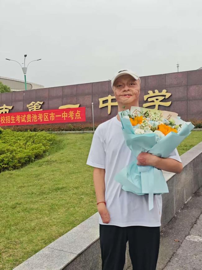 燒傷男孩雙拳緊握筆桿考出664分