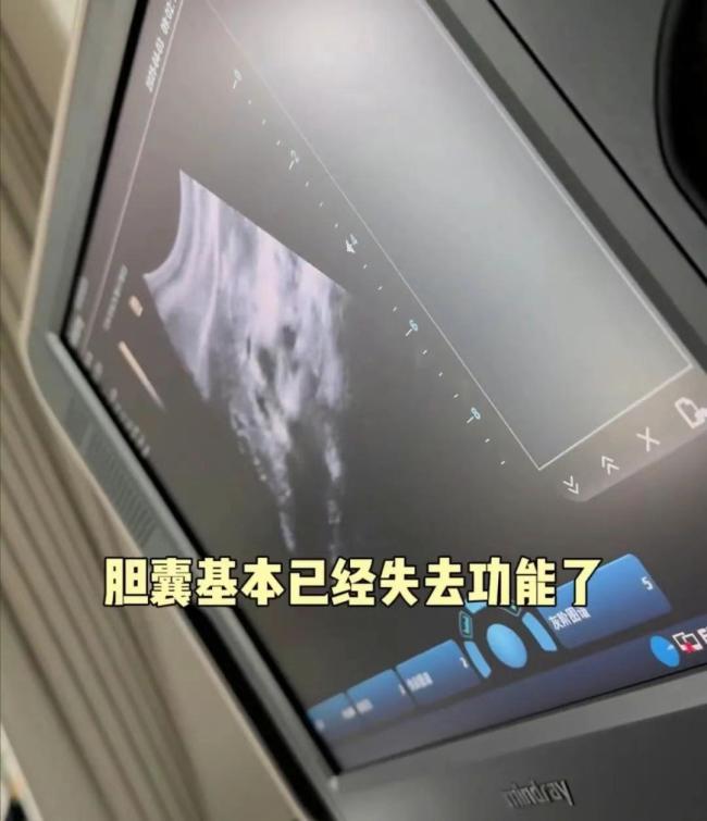 穎兒膽囊結(jié)石住院做手術(shù) 明星健康引發(fā)關(guān)注