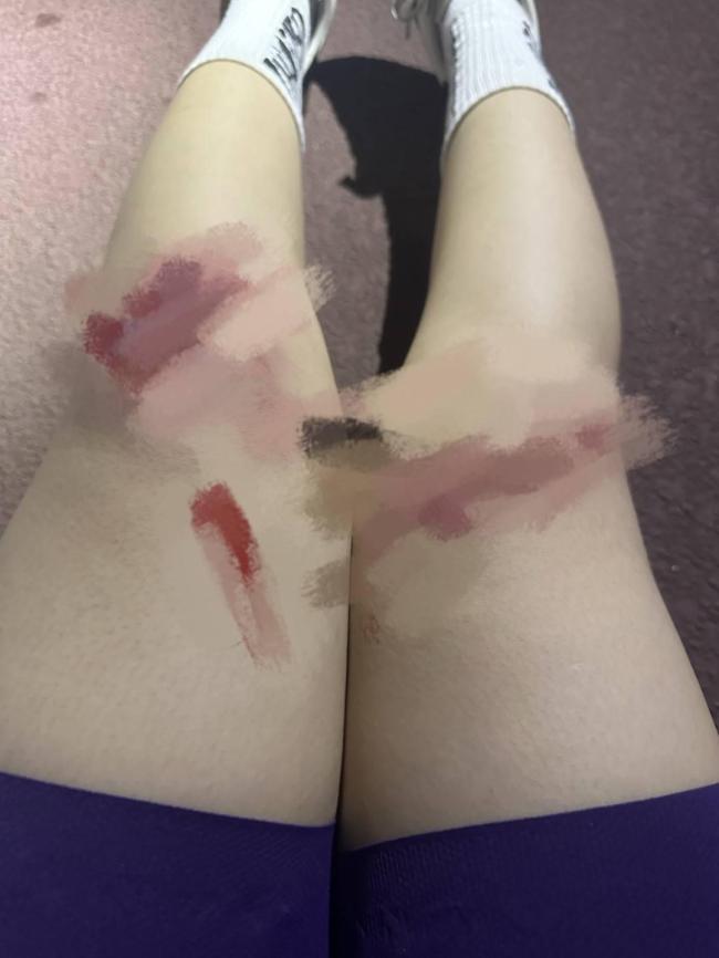女子在成都绿道骑行被鱼线绊倒 安全隐患引关注