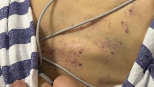 女子上厕所被蛇咬口吐鲜血命悬一线