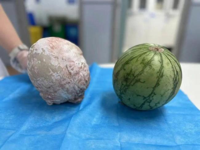 老人尿频5年膀胱长巨型结石 罕见病例震惊医生