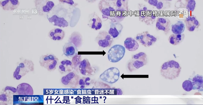 玩水會(huì)感染“食腦蟲”,？護(hù)鼻是關(guān)鍵