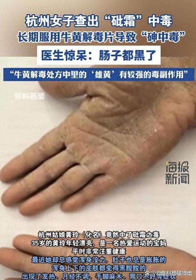 女子2年日服10粒牛黄解毒片中毒 皮肤黑变警示信号