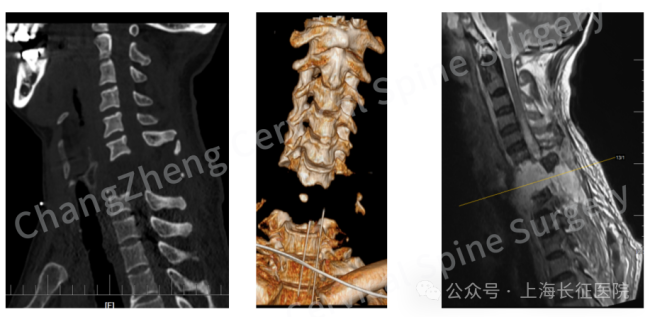 全球罕见！“身首离断”患者被救回