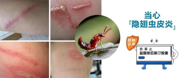 天津多地出现隐翅虫 科学防治方法需掌握