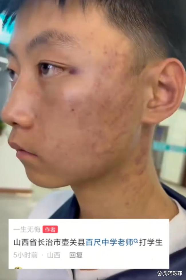 媒体评老师打学生致多处淤痕