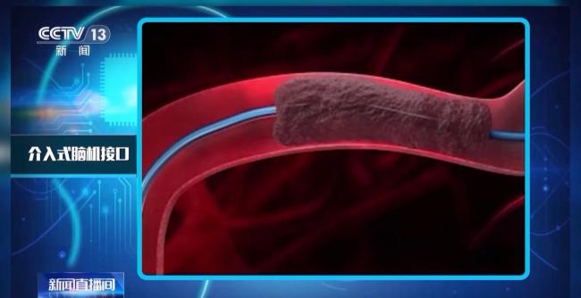 我國腦機接口技術(shù)走向臨床 受試者體驗如何？
