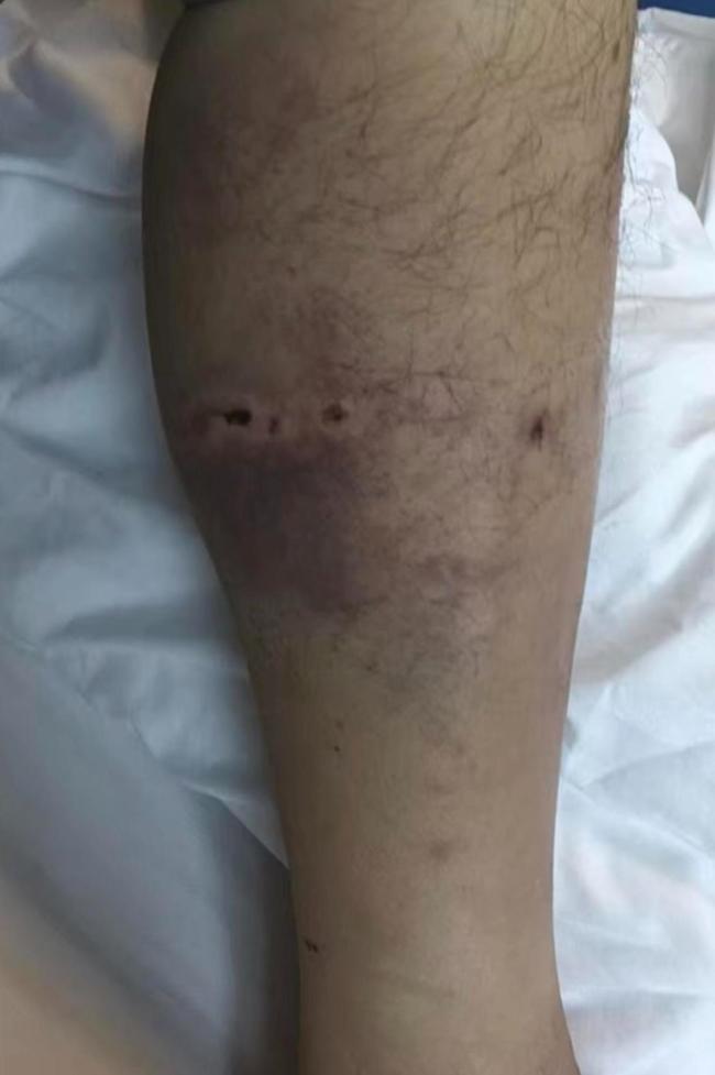 男子采菌遭黑熊一巴掌打下山昏迷 村民紧急救援