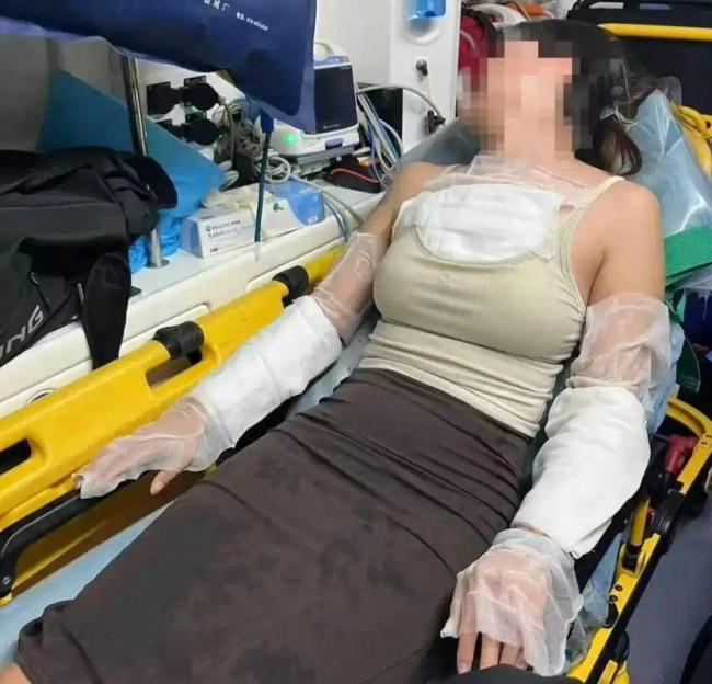 被泼开水烫伤当事人确诊抑郁 事件引发广泛关注