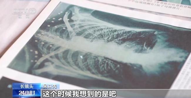 33个弹片成为老兵摘不掉的“项链” 一段不平凡的往事