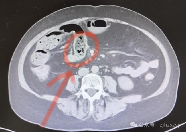 女子连吃好几个柿子致肠梗阻 小肠内已形成大量柿石比鸡蛋还大