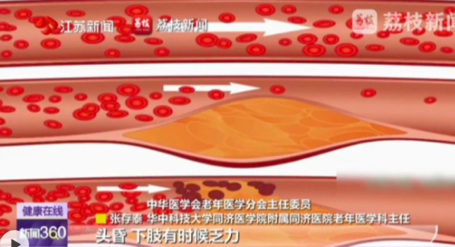 35岁男子爱熬夜血管年龄达70岁 血管提前衰老有哪些信号